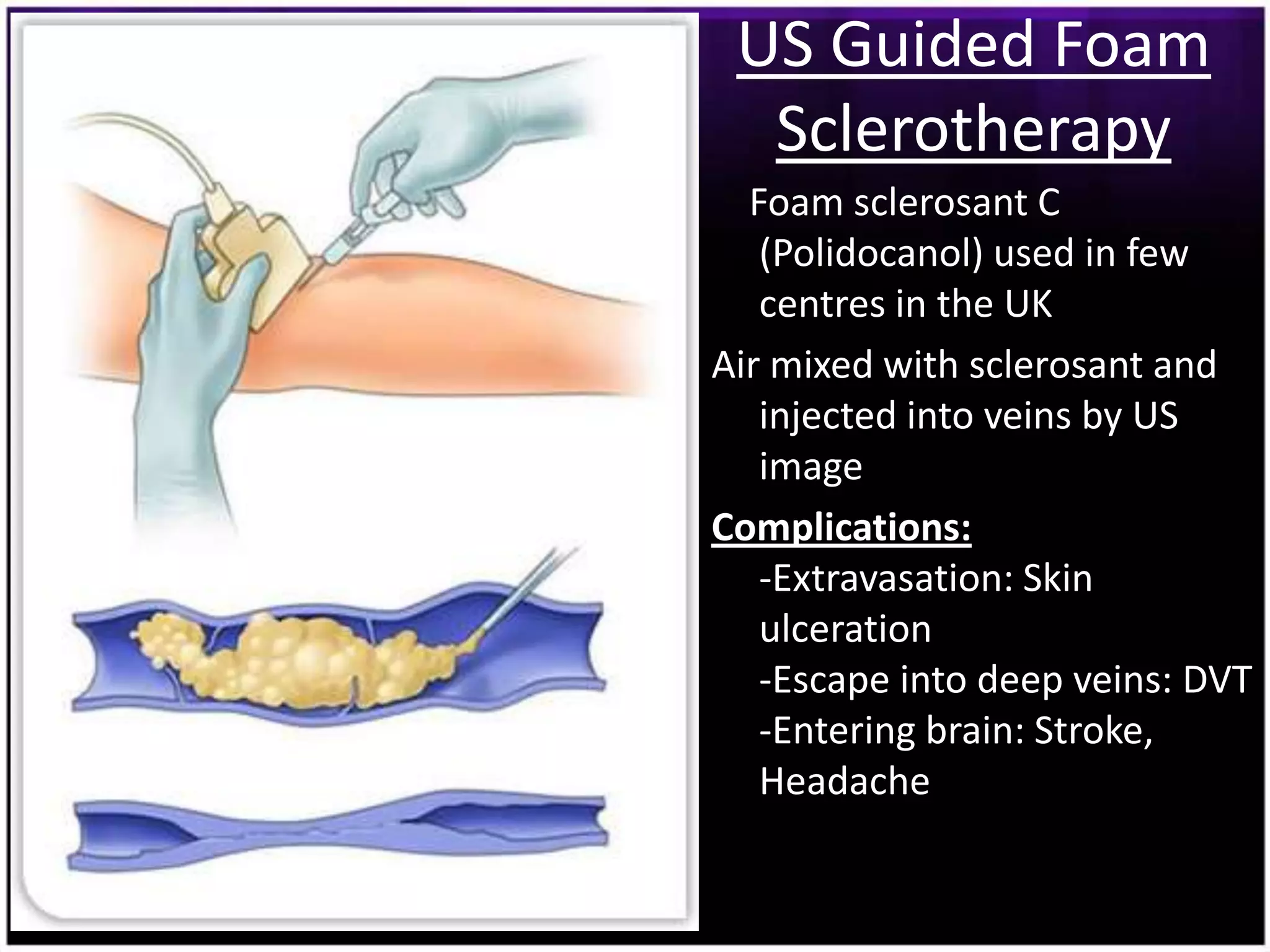 US Guided Foam
  Sclerotherapy
  Foam sclerosant C
   (Polidocanol) used in few
   centres in the UK
Air mixed with sclerosant and
   injected into veins by US
   image
Complications:
   -Extravasation: Skin
   ulceration
   -Escape into deep veins: DVT
   -Entering brain: Stroke,
   Headache
 