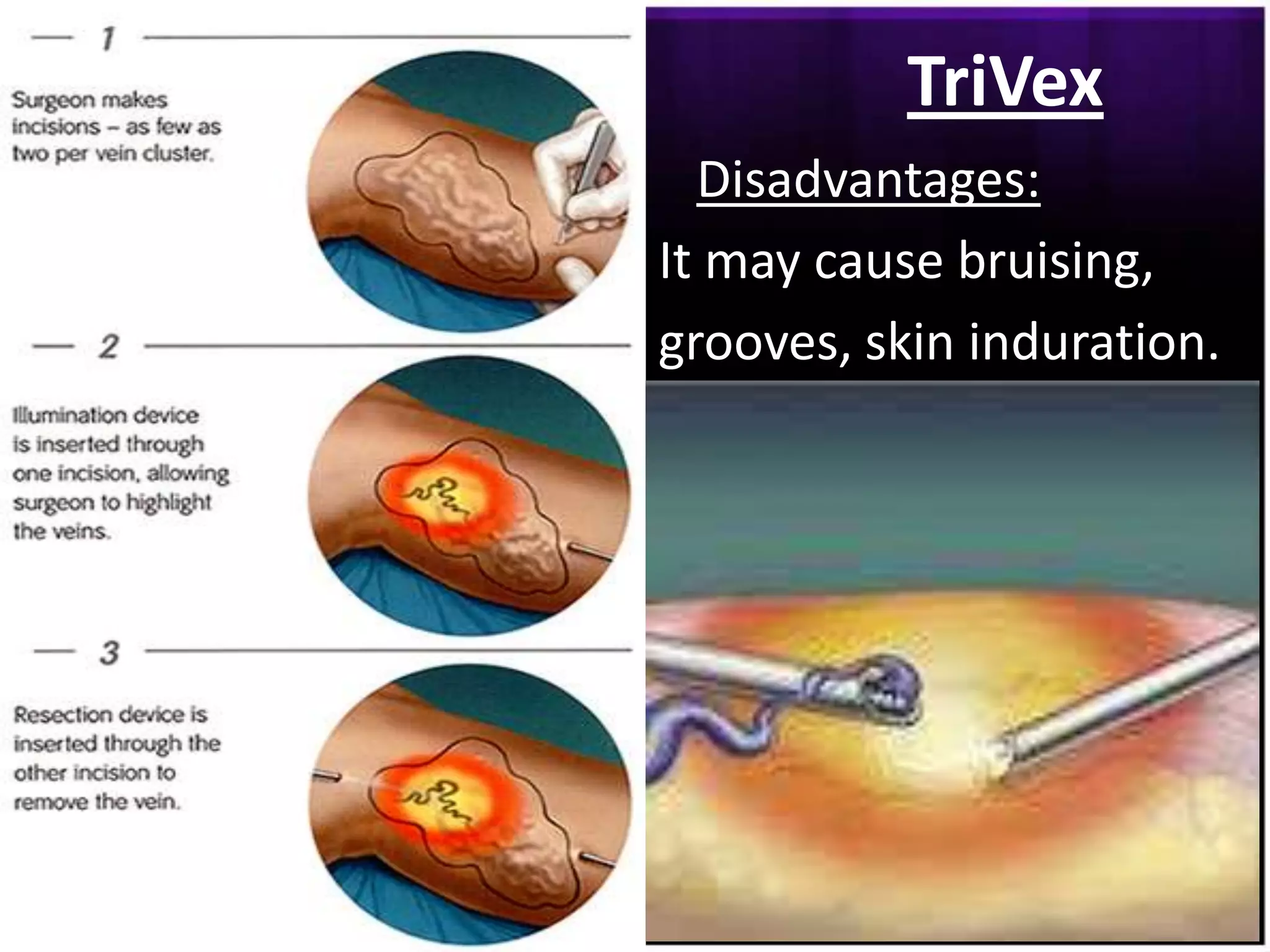 TriVex
  Disadvantages:
It may cause bruising,
grooves, skin induration.
 