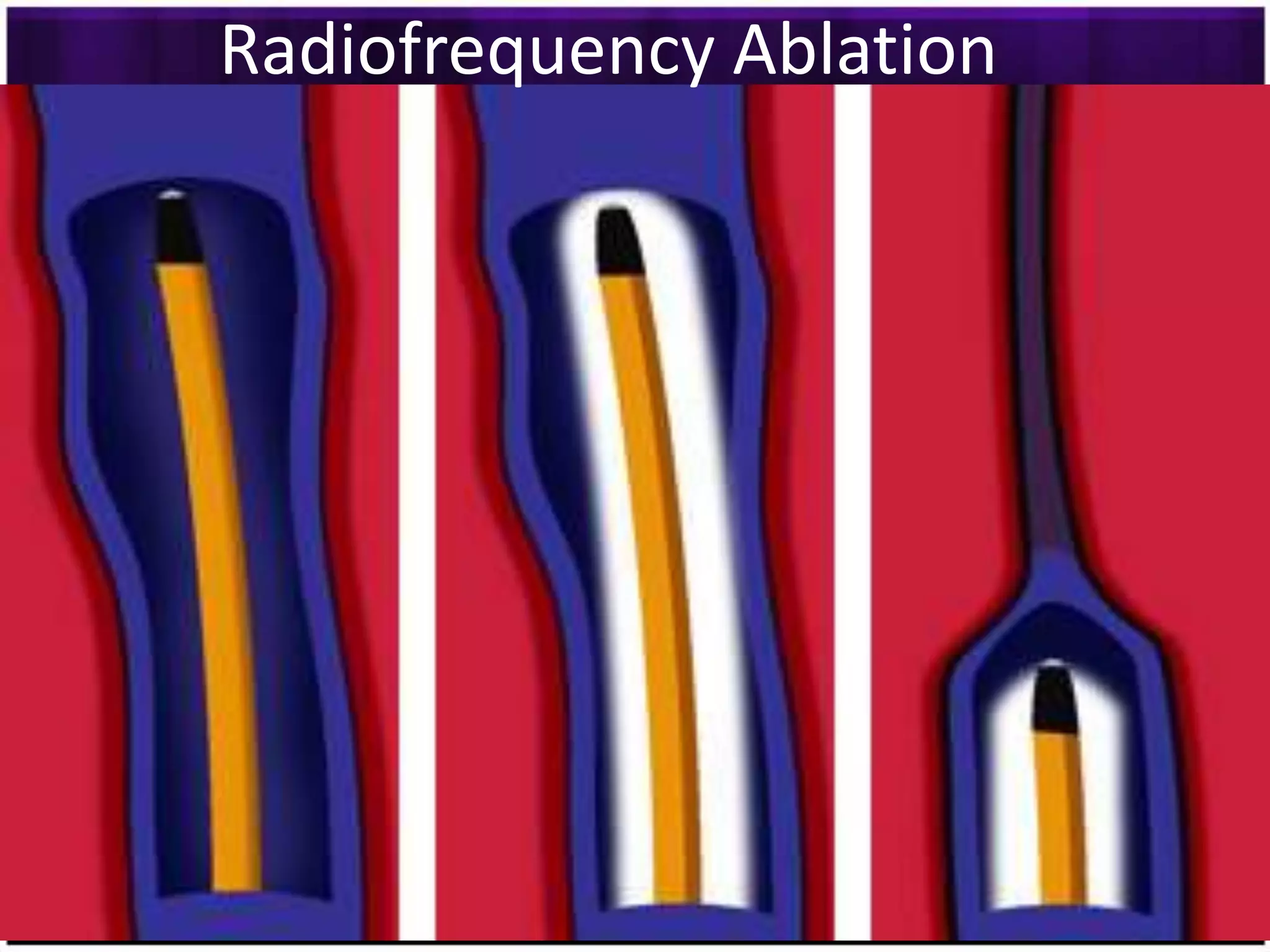 Radiofrequency Ablation
 
