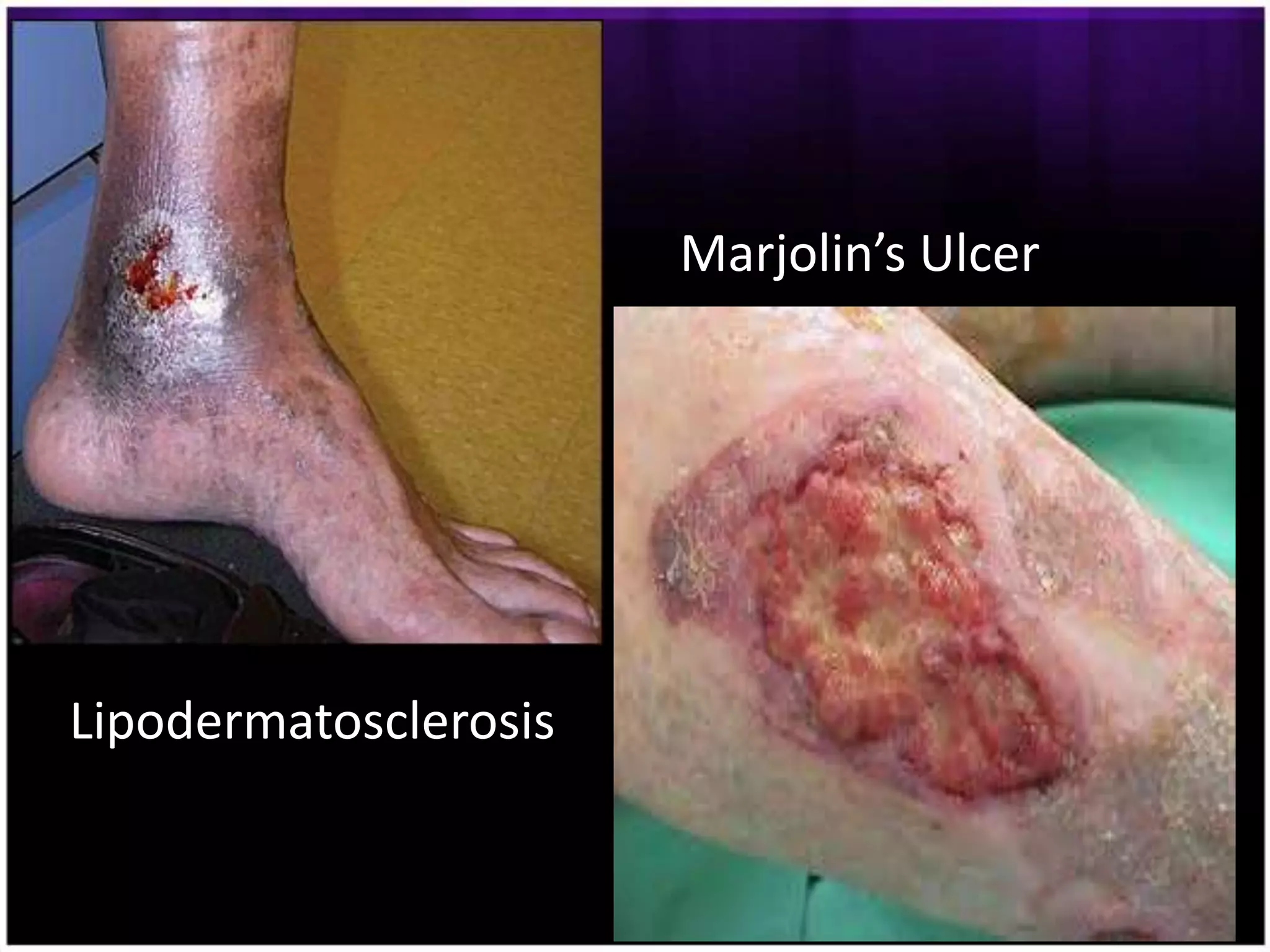 Marjolin’s Ulcer




Lipodermatosclerosis
 