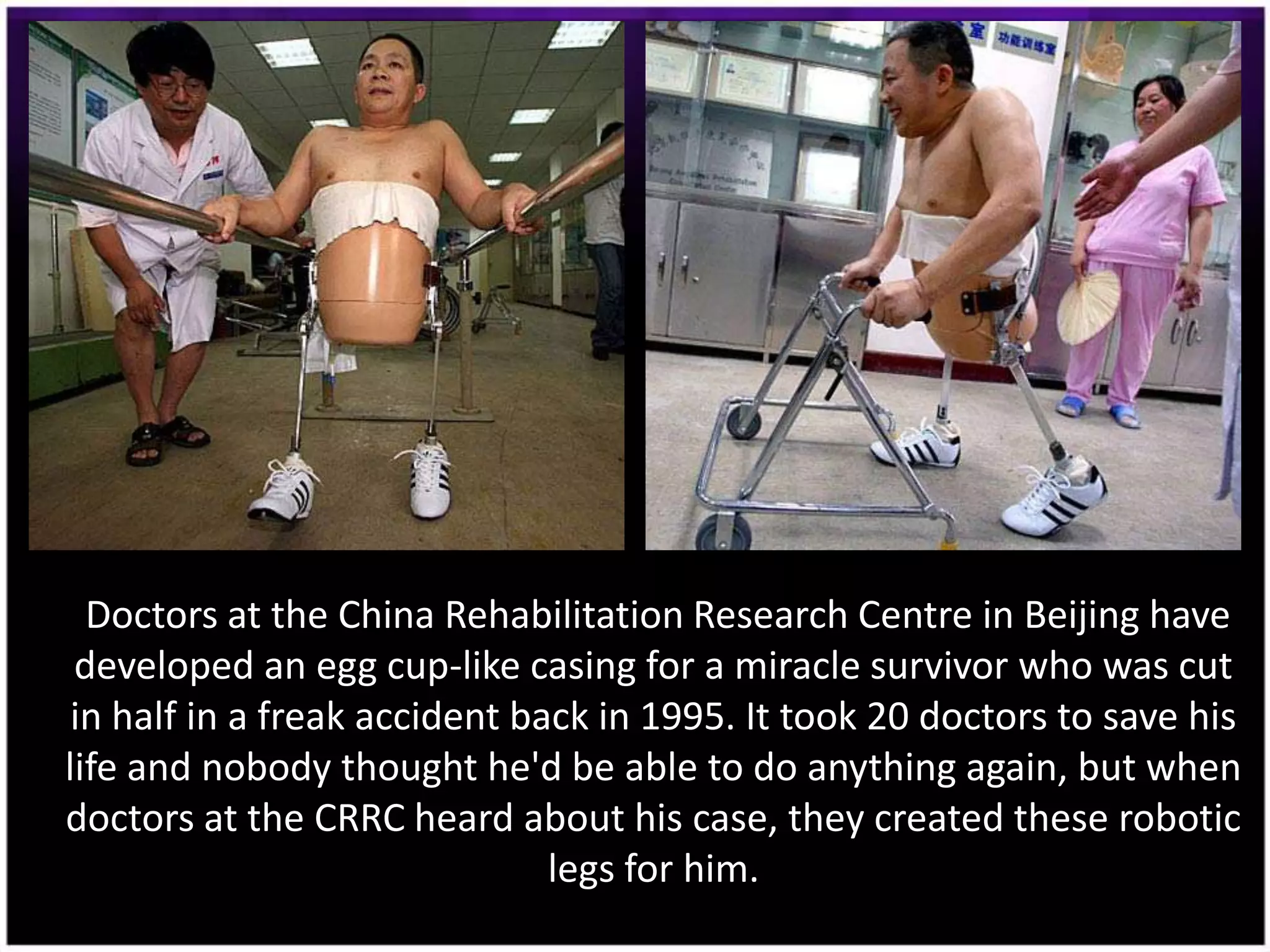 Doctors at the China Rehabilitation Research Centre in Beijing have
 developed an egg cup-like casing for a miracle survivor who was cut
 in half in a freak accident back in 1995. It took 20 doctors to save his
life and nobody thought he'd be able to do anything again, but when
doctors at the CRRC heard about his case, they created these robotic
                               legs for him.
 