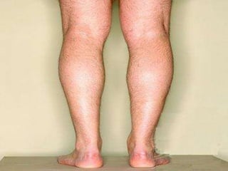 Management of varicose veins RRT