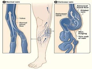 Management of varicose veins RRT