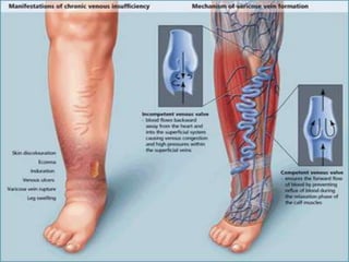 Management of varicose veins RRT