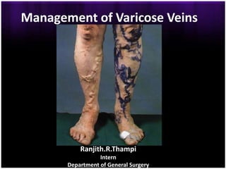 Management of Varicose Veins




           Ranjith.R.Thampi
                  Intern
       Department of General Surgery
 