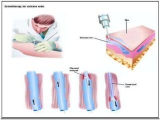 Management of varicose veins RRT