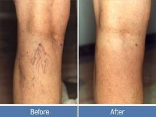 Management of varicose veins RRT