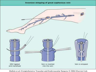 Management of varicose veins RRT