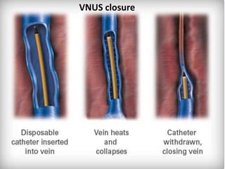 VNUS closure
 
