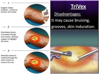 TriVex
  Disadvantages:
It may cause bruising,
grooves, skin induration.
 