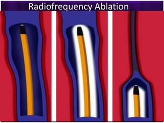 Radiofrequency Ablation
 