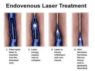 Management of varicose veins RRT