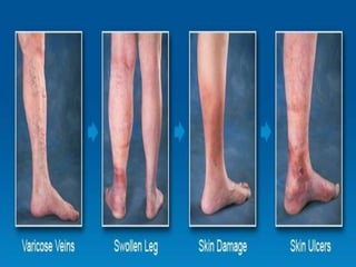 Management of varicose veins RRT