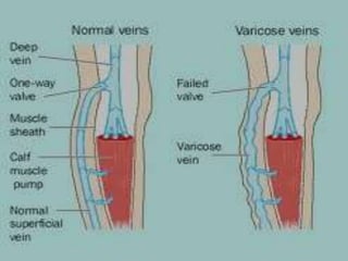 Management of varicose veins RRT