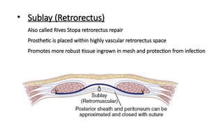 Sublay Retrorectus Management of ventral Hernia final_15105221-65e4-41c4-bf2f-19234f0e30f0 ...