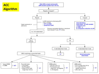 Vtac Algorithm Management of ventricular tachyarrythmias | PPTX