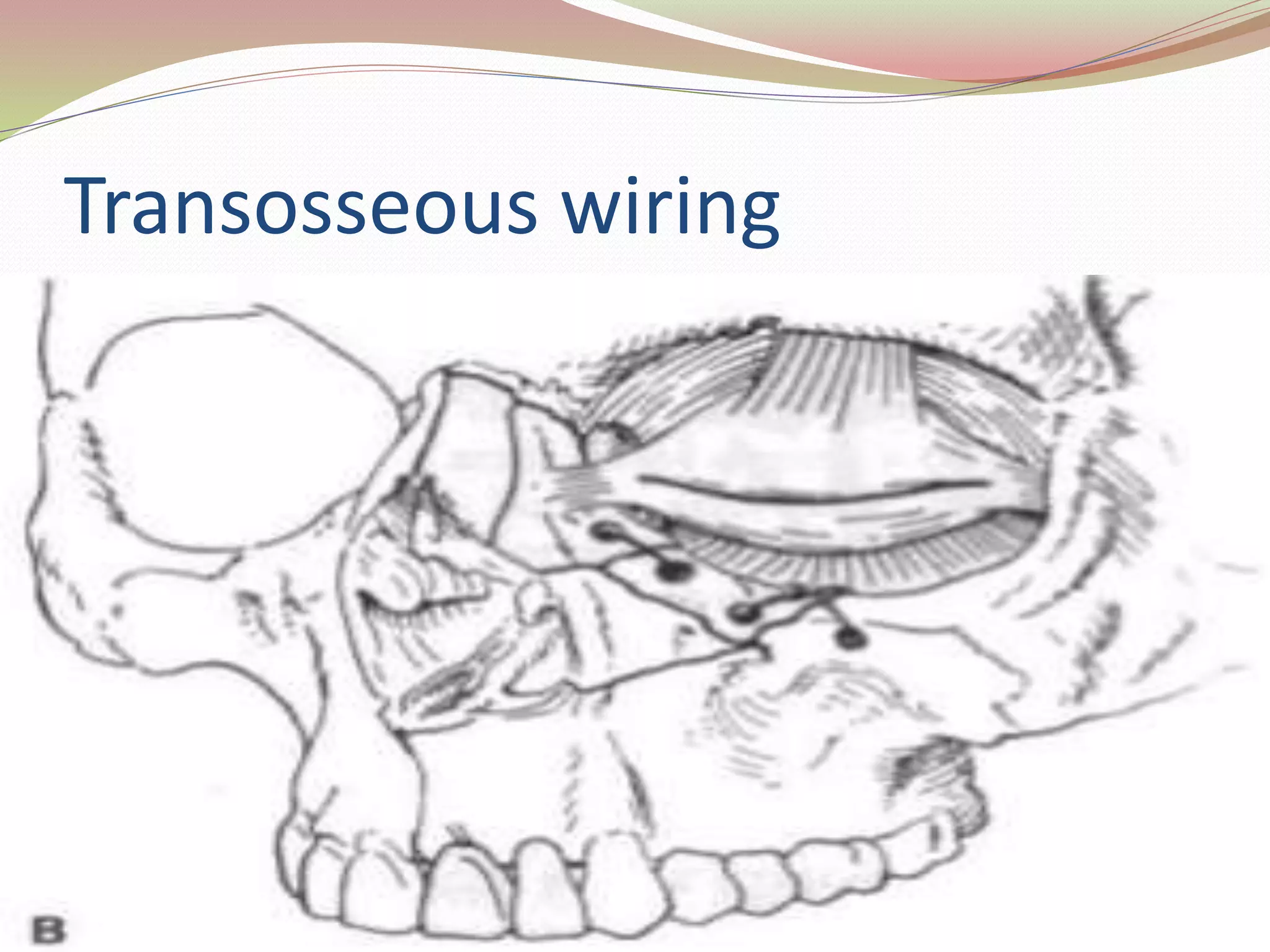 Management of zygomatic complex fractures | PPTX