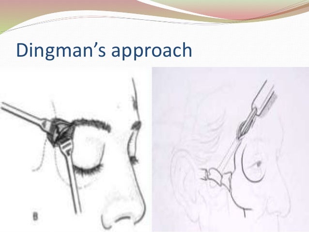 Management of zygomatic complex fractures