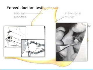 Management of zygomaticomaxillary complex fractures ih | PPTX