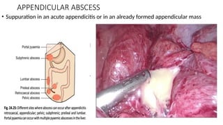 APPENDICULAR ABSCESS
• Suppuration in an acute appendicitis or in an already formed appendicular mass
 