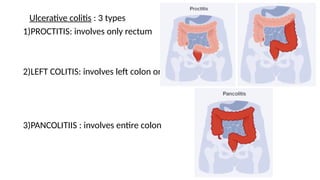 Protitis Colitis Management principles of inflammatory bowel disease.pptx