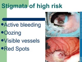 Stigmata of high risk Active bleeding Oozing Visible vessels  Red Spots 