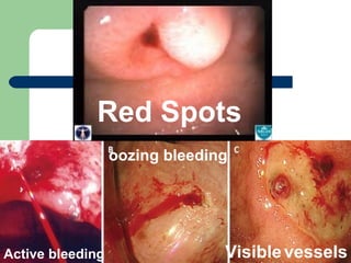 Visible   vessels oozing bleeding  Active bleeding Red Spots 