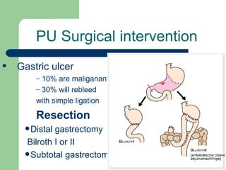 PU Surgical intervention Gastric ulcer 10% are maliganant 30% will rebleed  with simple ligation Resection Distal gastrectomy Bilroth I or II  Subtotal gastrectomy 