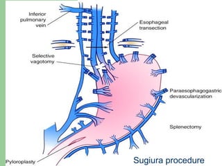 Sugiura procedure 