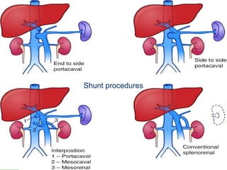 Shunt procedures 