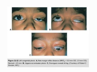 managemwnt of ptosis.pptx