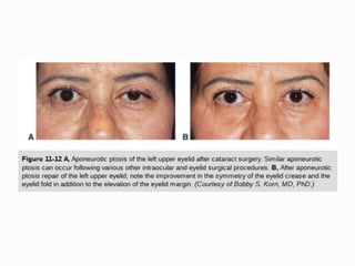 managemwnt of ptosis.pptx