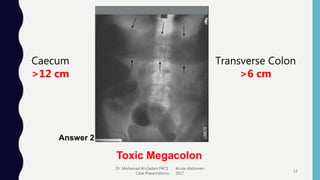 Dr. Mohamad Al-Gailani FRCS Acute Abdomen
Case Presentations 2017
12
Answer 2
Toxic Megacolon
Caecum
>12 cm
Transverse Colon
>6 cm
 