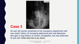 Dr. Mohamad Al-Gailani FRCS Acute Abdomen
Case Presentations 2017
15
Case 3
62 year old woman presented to the emergency department with
one week's history of increasing abdominal pain and distension.
She gave a long history of chronic constipation, but was otherwise
fit and well. What does the X-ray show?
 