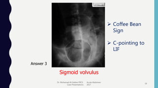 Dr. Mohamad Al-Gailani FRCS Acute Abdomen
Case Presentations 2017
16
Answer 3
Sigmoid volvulus
 Coffee Bean
Sign
 C-pointing to
LIF
 