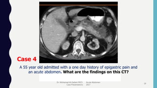 Dr. Mohamad Al-Gailani FRCS Acute Abdomen
Case Presentations 2017
19
Case 4
A 55 year old admitted with a one day history of epigastric pain and
an acute abdomen. What are the findings on this CT?
 