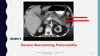 Answer 4
Severe Necrotizing Pancreatitis
Dr. Mohamad Al-Gailani FRCS Acute Abdomen
Case Presentations 2017
20
 
