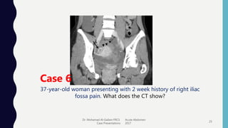 Dr. Mohamad Al-Gailani FRCS Acute Abdomen
Case Presentations 2017
25
Case 6
37-year-old woman presenting with 2 week history of right iliac
fossa pain. What does the CT show?
 