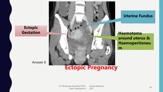 Dr. Mohamad Al-Gailani FRCS Acute Abdomen
Case Presentations 2017
26
Answer 6
Ectopic Pregnancy
Ectopic
Gestation Haematoma
around uterus &
Haemoperitoneu
m
Uterine Fundus
 