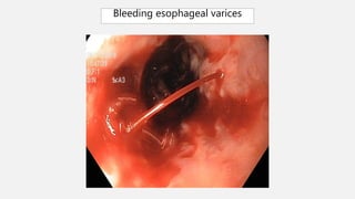 Bleeding esophageal varices
 