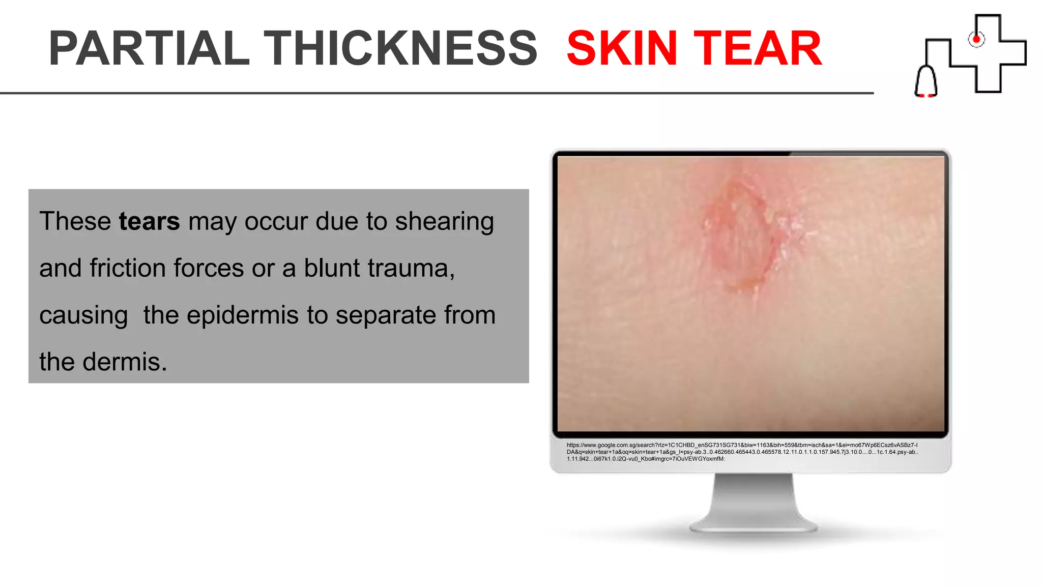 PARTIAL THICKNESS SKIN TEAR
https://www.google.com.sg/search?rlz=1C1CHBD_enSG731SG731&biw=1163&bih=559&tbm=isch&sa=1&ei=mo67Wp6ECsz6vASBz7-I
DA&q=skin+tear+1a&oq=skin+tear+1a&gs_l=psy-ab.3..0.462660.465443.0.465578.12.11.0.1.1.0.157.945.7j3.10.0....0...1c.1.64.psy-ab..
1.11.942...0i67k1.0.i2Q-vu0_Kbo#imgrc=7iOuVEWGYoxmfM:
These tears may occur due to shearing
and friction forces or a blunt trauma,
causing the epidermis to separate from
the dermis.
 