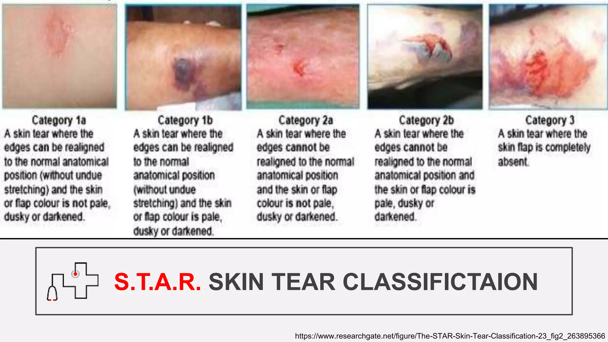 S.T.A.R. SKIN TEAR CLASSIFICTAION
https://www.researchgate.net/figure/The-STAR-Skin-Tear-Classification-23_fig2_263895366
 