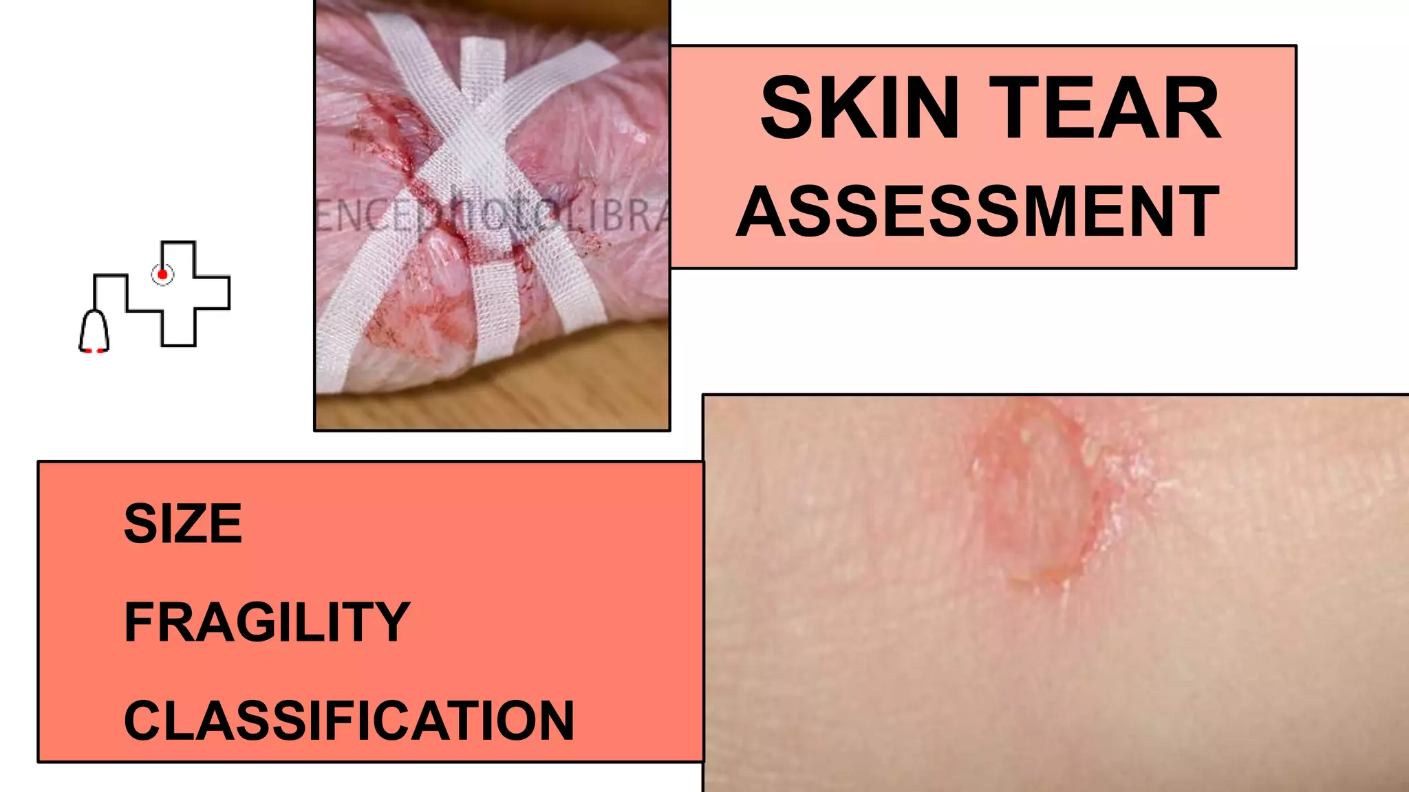 SKIN TEAR
ASSESSMENT
SIZE
FRAGILITY
CLASSIFICATION
 