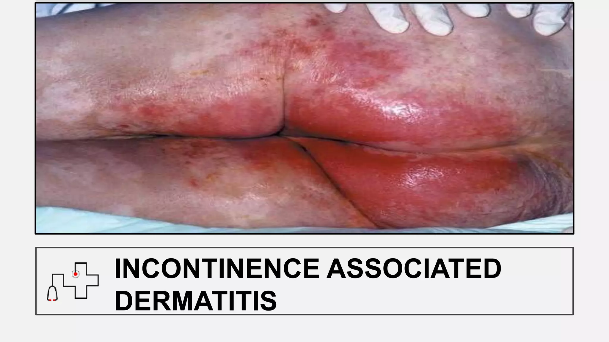 INCONTINENCE ASSOCIATED
DERMATITIS
 