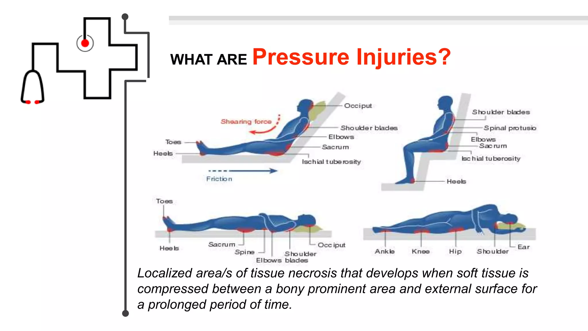 WHAT ARE Pressure Injuries?
Localized area/s of tissue necrosis that develops when soft tissue is
compressed between a bony prominent area and external surface for
a prolonged period of time.
 