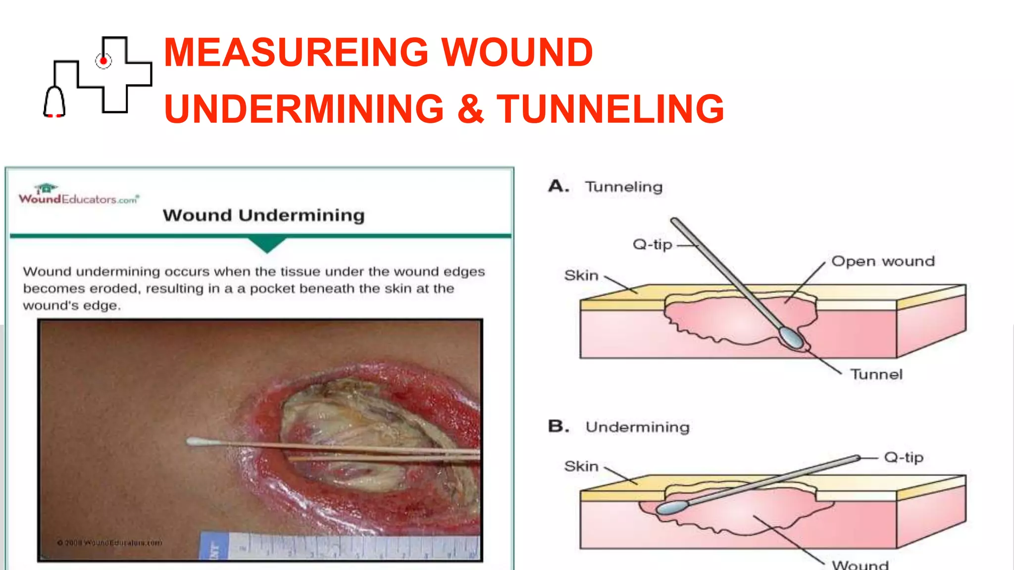MEASUREING WOUND
UNDERMINING & TUNNELING
 