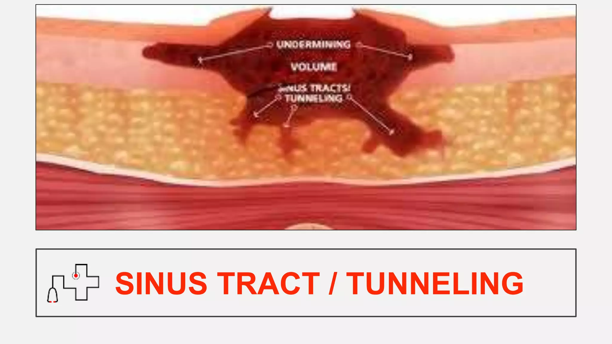 SINUS TRACT / TUNNELING
 