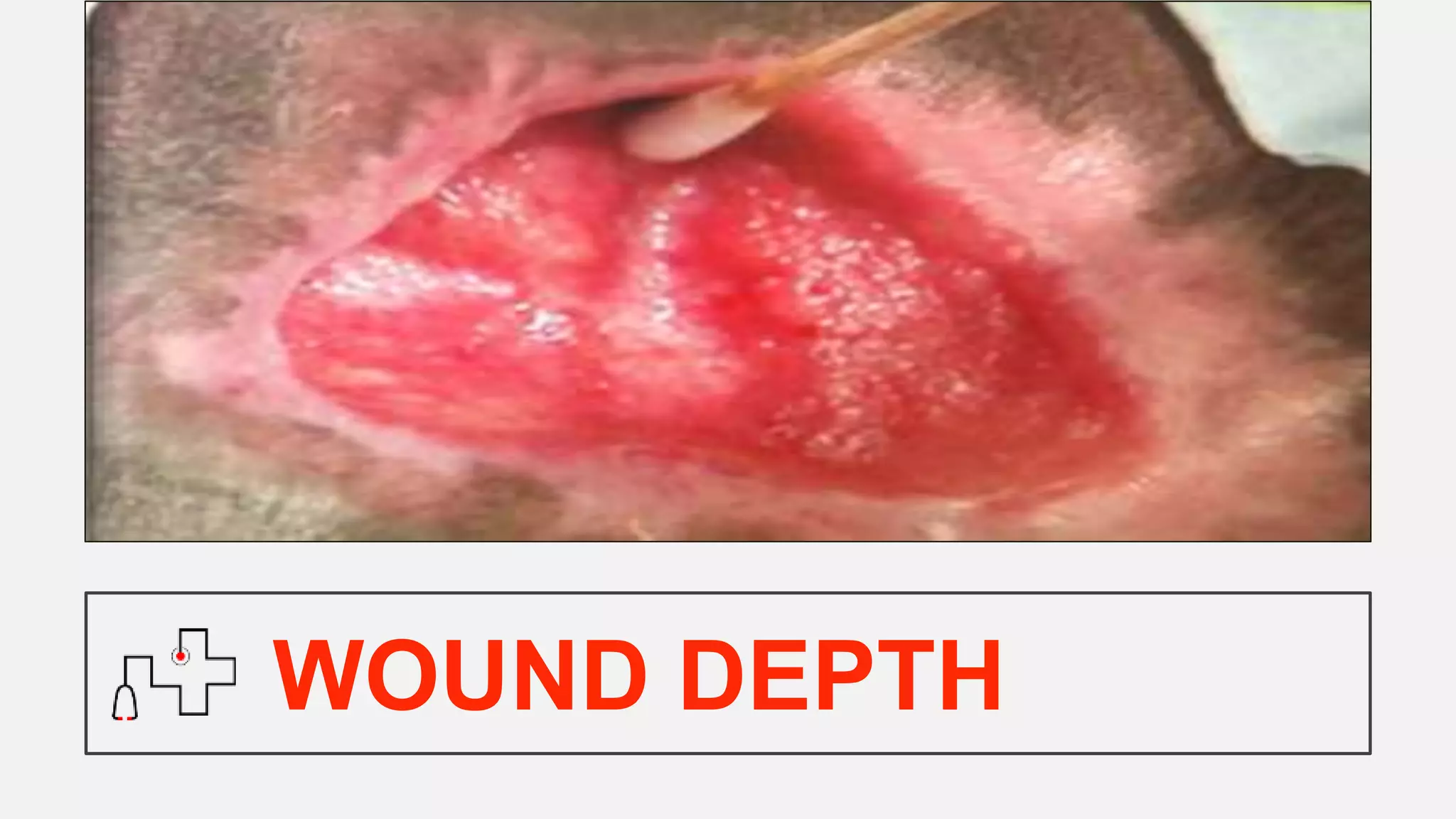 WOUND DEPTH
 