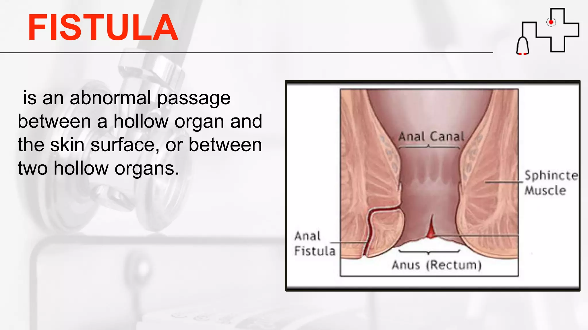 FISTULA
is an abnormal passage
between a hollow organ and
the skin surface, or between
two hollow organs.
 