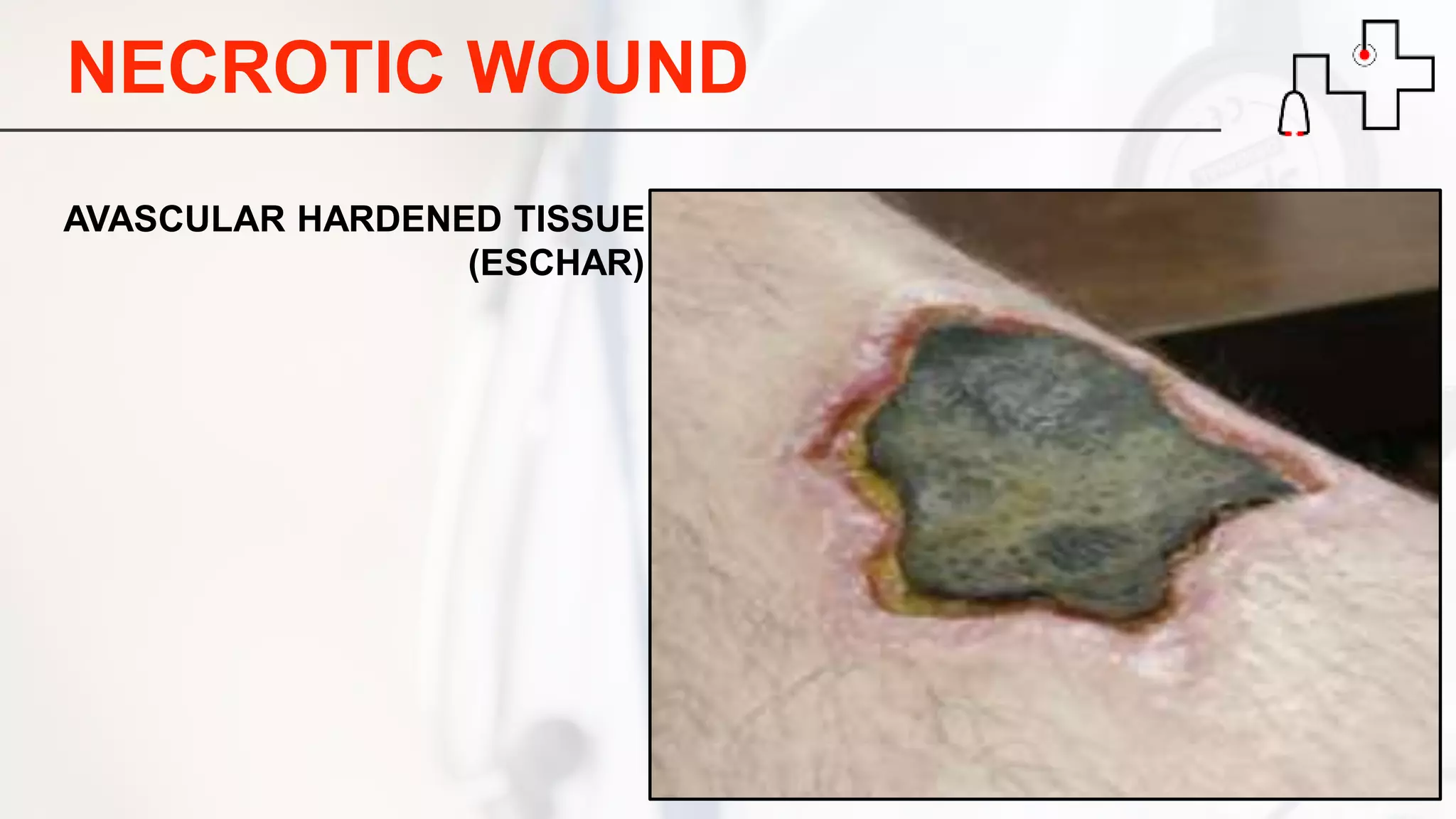 NECROTIC WOUND
AVASCULAR HARDENED TISSUE
(ESCHAR)
 